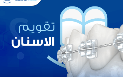 تقويم الاسنان – ما هي أنواع تقويم الاسنان؟
