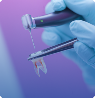معالجة عصب الأسنان