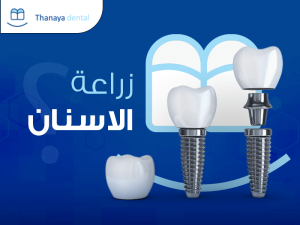 عملية زراعة الأسنان: كل ما تحتاج إلى معرفته 1 عملية زراعة الاسنان
