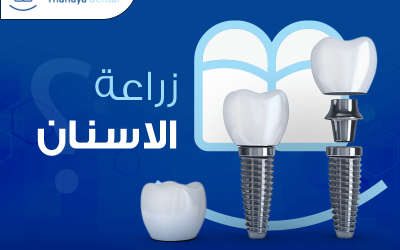 ما هي عملية زراعة الاسنان؟
