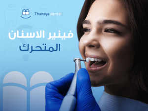 ما هو فينير الاسنان المتحرك ؟ 1 فينير الاسنان المتحرك