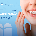 أسعار تقويم الأسنان في مصر