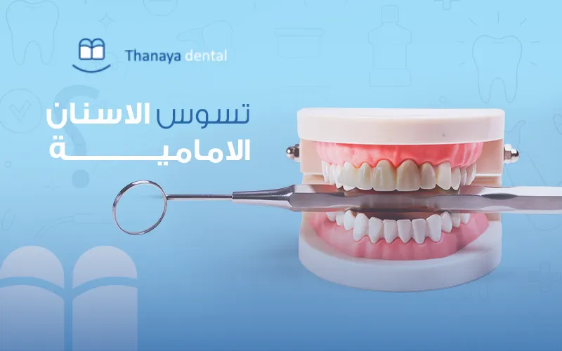 تعرّف على أسباب تسوس الأسنان الأمامية وكيفية الوقاية منها
